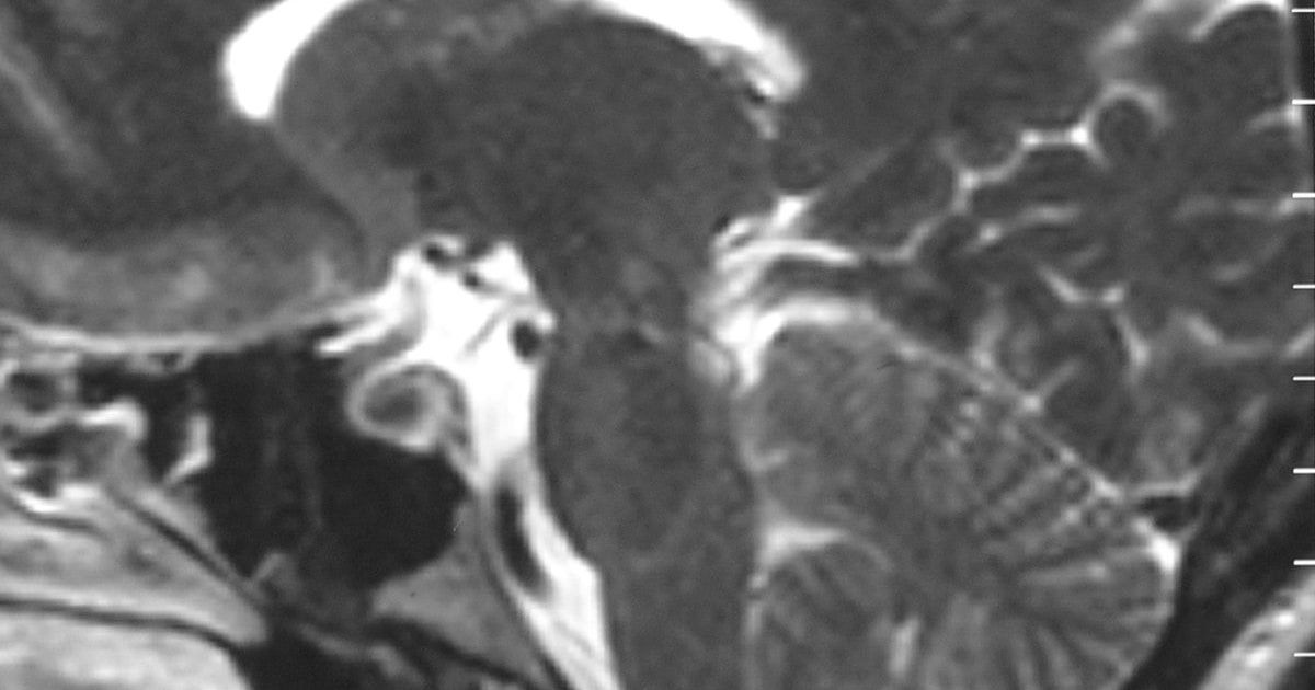 A T2-weighted sagittal MRI scan, from a patient with Chiari-like symptomatology, demonstrating tonsillar herniation les…