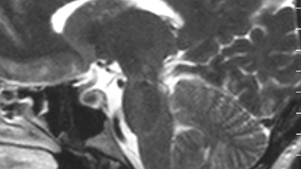 A T2-weighted sagittal MRI scan, from a patient with Chiari-like symptomatology, demonstrating tonsillar herniation les…